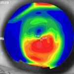 Cornea Irregular